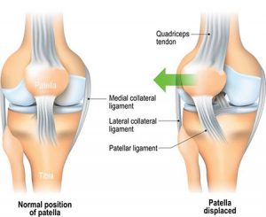 patella knee pain