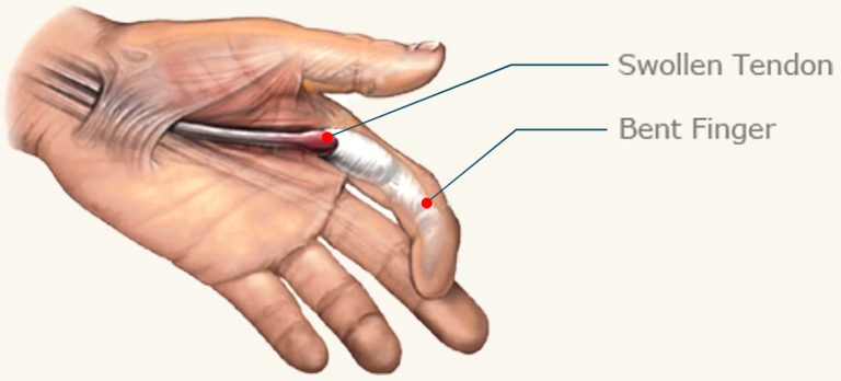 trigger-finger-physical-therapist-overview-physiotherapists-in-tralee