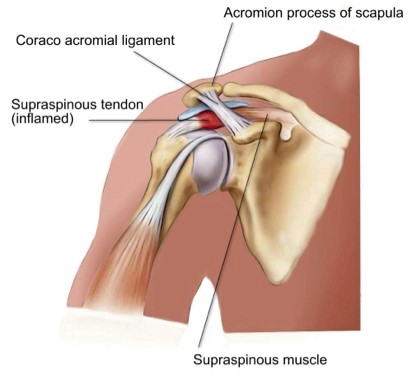 Treatments for a Shoulder Impingement