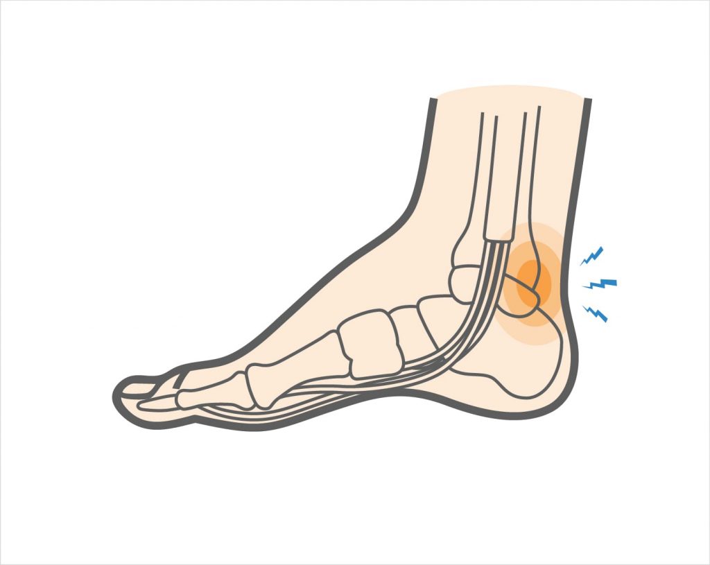 Posterior Ankle Impingement - Eddie O'Grady Physiotherapist